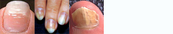 IIIh - Fingernails